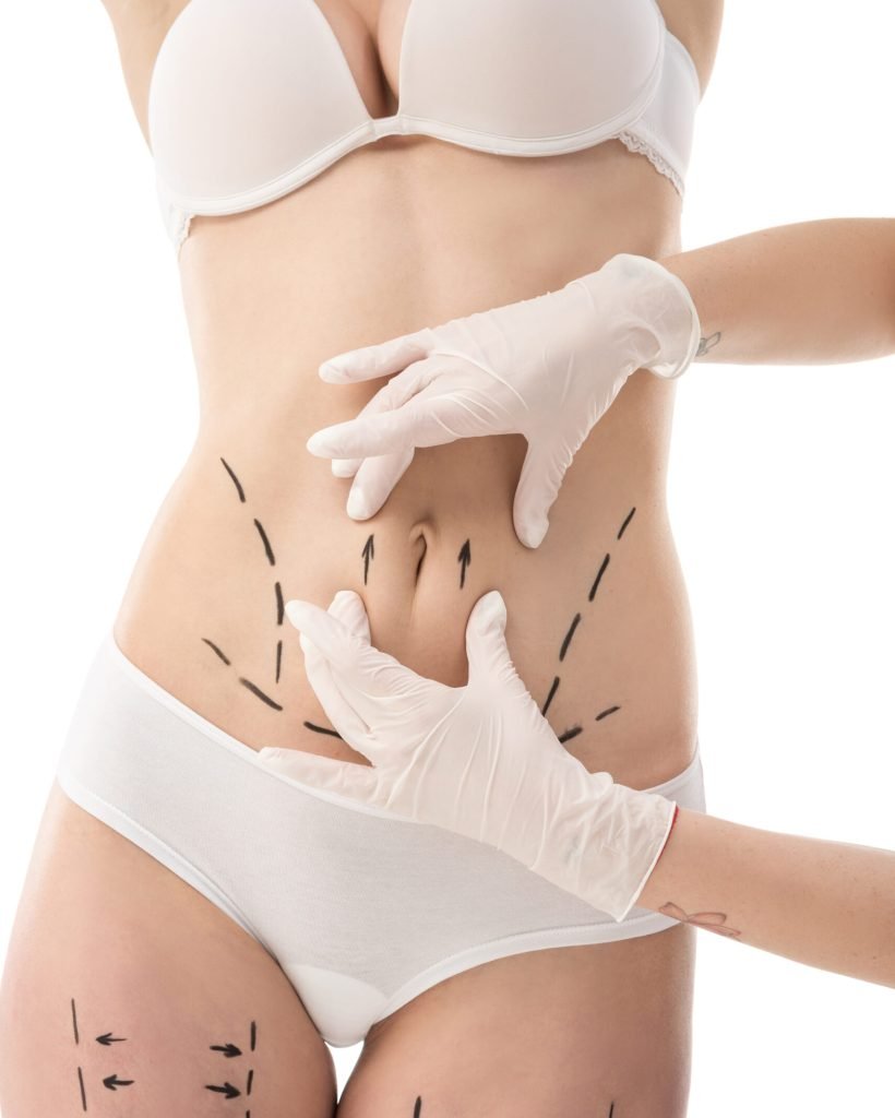 partial view of plastic surgeon in latex gloves and patient in underwear with marks on body isolated